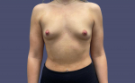 Breast Augmentation 28 Before